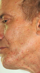 marks on the face of Mitch Miller after he was shot on Greyhound, June 1, 2009